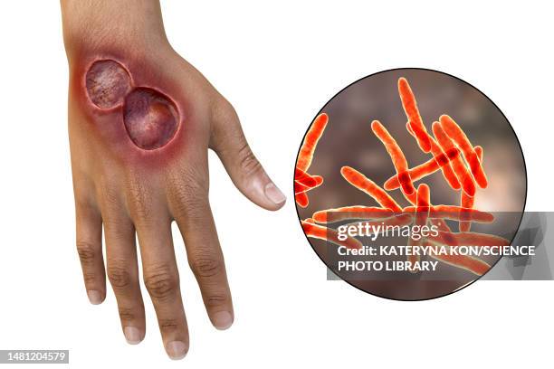 buruli ulcer and mycobacterium ulcerans, illustration - mycobacterium stock illustrations