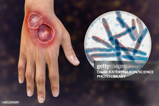 buruli ulcer and mycobacterium ulcerans, illustration - mycobacterium stock illustrations