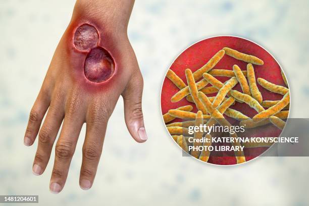 buruli ulcer and mycobacterium ulcerans, illustration - mycobacterium stock illustrations