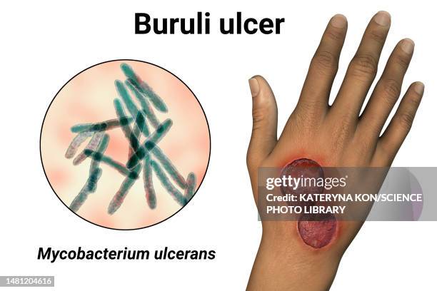 buruli ulcer and mycobacterium ulcerans, illustration - mycobacterium stock illustrations