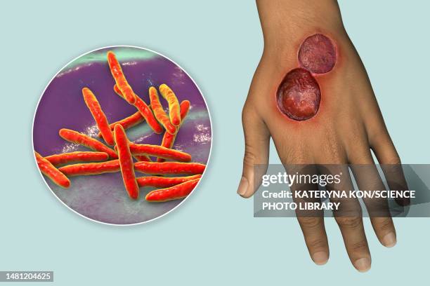 buruli ulcer and mycobacterium ulcerans, illustration - mycobacterium stock illustrations
