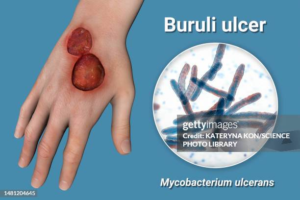 buruli ulcer and mycobacterium ulcerans, illustration - mycobacterium stock illustrations