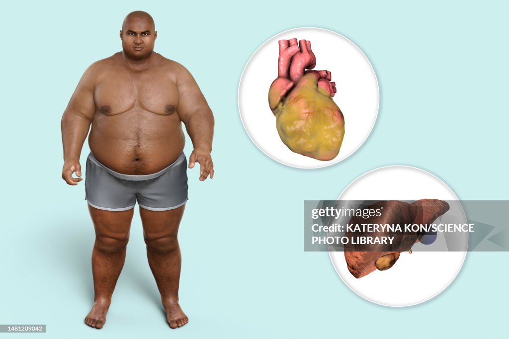Fatty heart and liver in overweight man, illustration