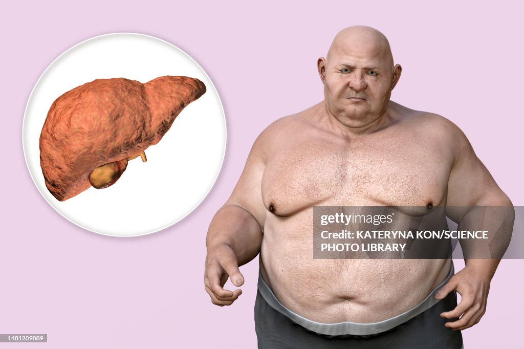 Fatty liver disease in an overweight man, illustration