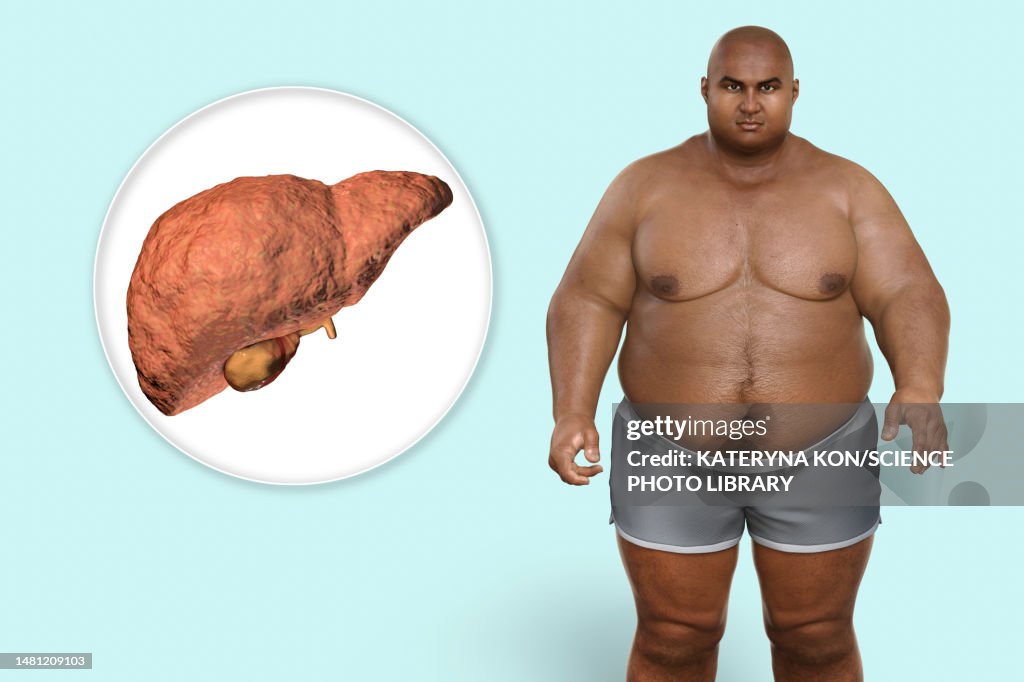 Fatty liver disease in an overweight man, illustration
