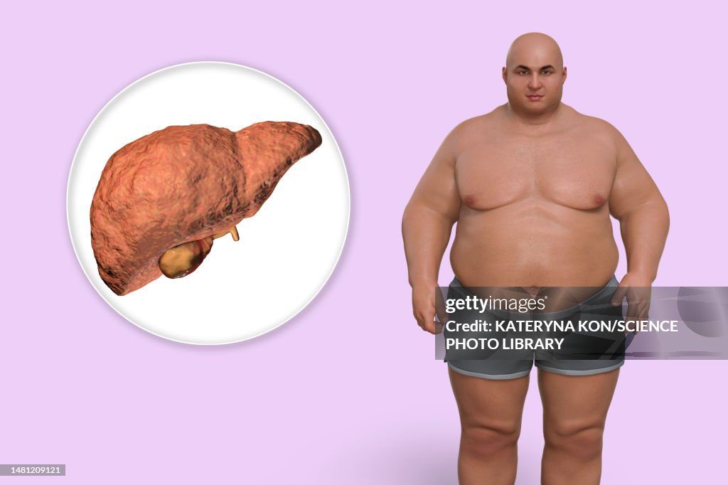 Fatty liver disease in an overweight man, illustration