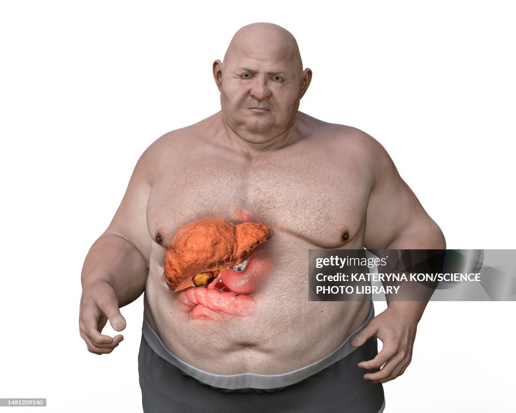 Fatty liver disease in an overweight man, illustration
