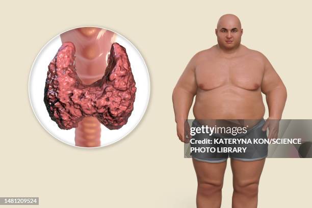 thyroid diseases and obesity, conceptual illustration - hypothyroidism stock illustrations