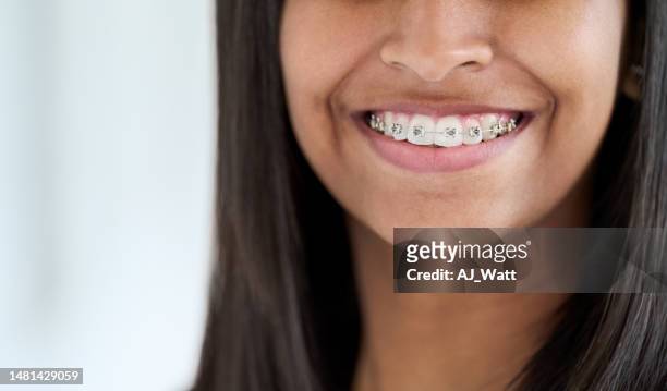 close-up of a smiling young woman with teeth braces - braces 個照片及圖片檔