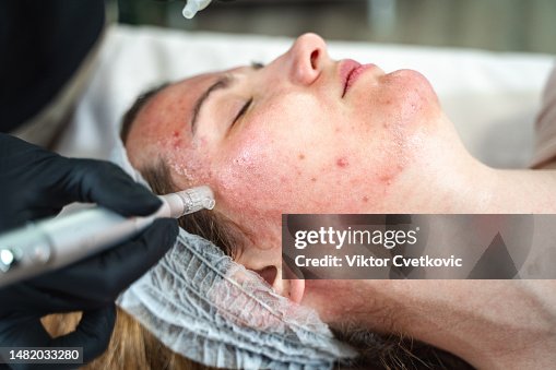 Young woman having cosmetic facial mesotherapy. Young woman having cosmetic facial mesotherapy.
