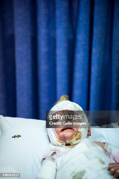 Isabella "Pippie" Kruger is covered in bandages in her room at the rehabilitation clinic where she is being treated on July 12, 2012 in Johannesburg,...