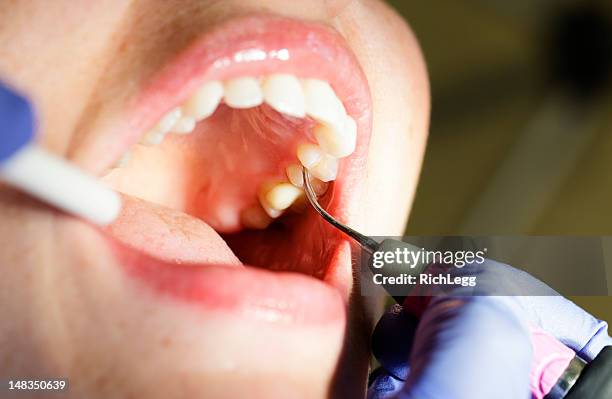 dental reinigung nahaufnahme - gingivitis stock-fotos und bilder