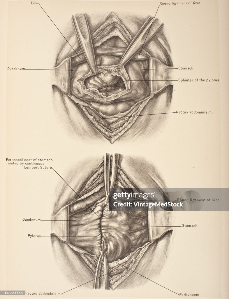 Incision & Sutured Wound In Pyloroplasy