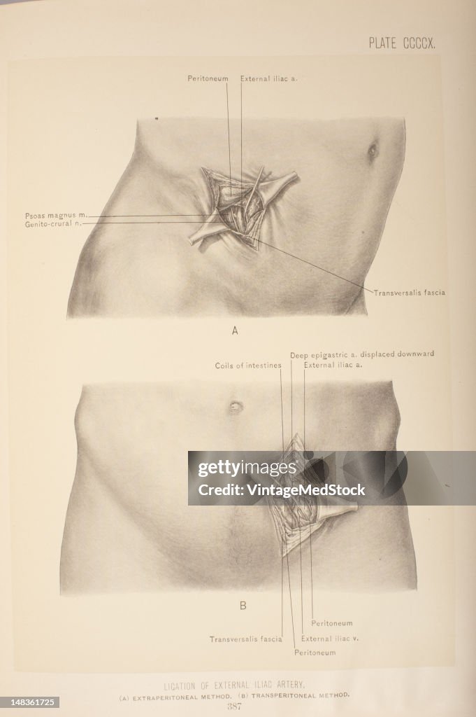 Ligation Of External Iliac Artery