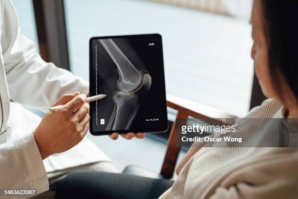 elevated view of doctor explaining medical scan result with patient during medical consultation - orthopedist stock pictures, royalty-free photos & images