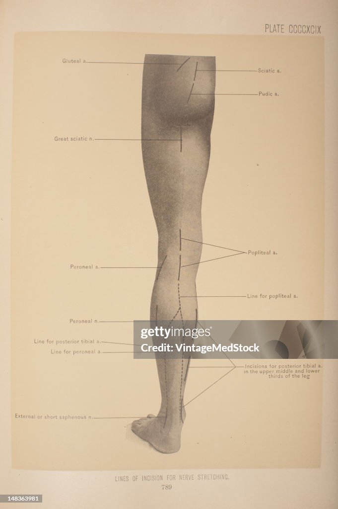 Lines Of Incision For Nerve Stretching