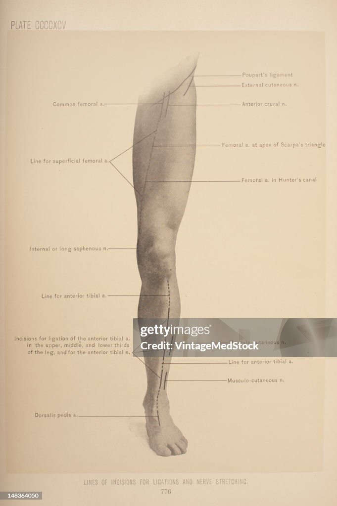 Lines Of Incision For Ligations & Nerve Stretching