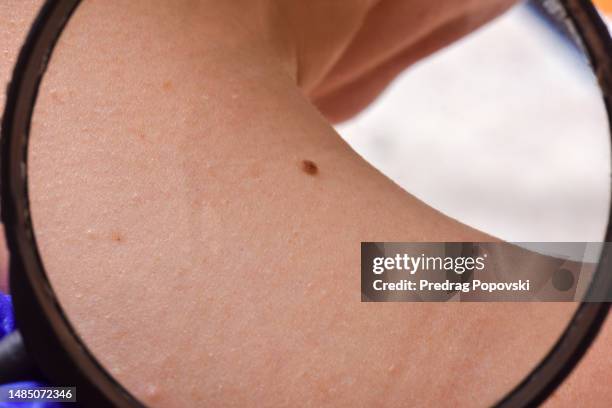 doctor checking mole with magnifying glass on woman back - mélanome photos et images de collection