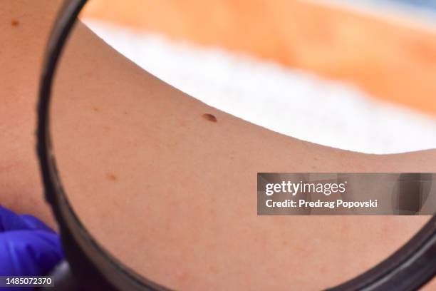 doctor checking mole with magnifying glass on woman back - melanoma foto e immagini stock