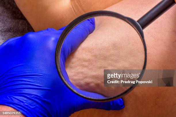 doctor examining woman cellulite on her leg with magnifying glass - セルライト ストックフォトと画像