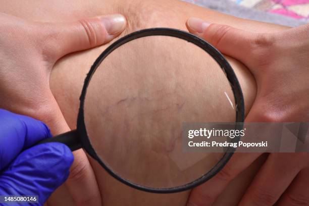 a woman's legs with spider veins and cellulite - vena humana fotografías e imágenes de stock