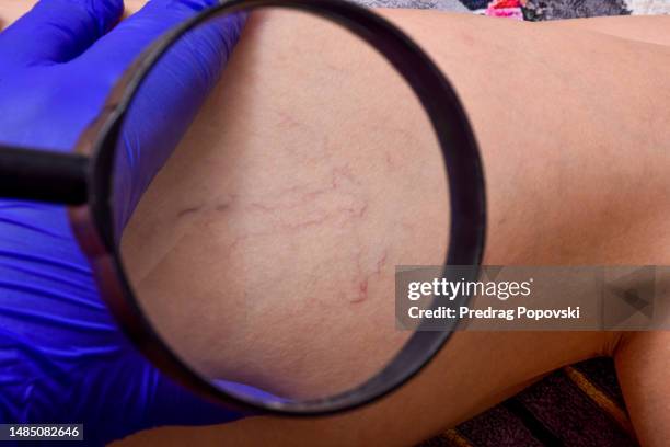 a woman's legs with varicose veins and spider veins - krampfader stock-fotos und bilder