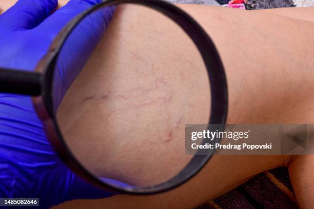 a woman's legs with varicose veins and spider veins - varices fotografías e imágenes de stock