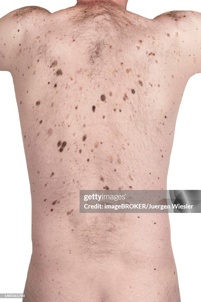 Cancer Birthmark Male Back With Moles Birthmarks And Age Warts Skin Cancer Risk Germany ...