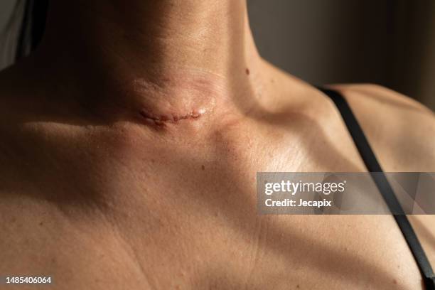 cicatriz quirúrgica en el cuello de una mujer después de la cirugía de tiroides - cicatriz fotografías e imágenes de stock