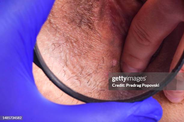 doctor checking infected skin with condyloma close up - condiloma fotografías e imágenes de stock