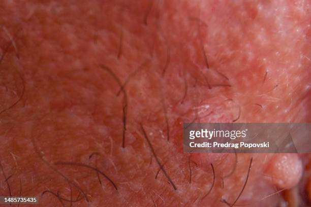 condyloma close up - sistema reprodutor feminino imagens e fotografias de stock