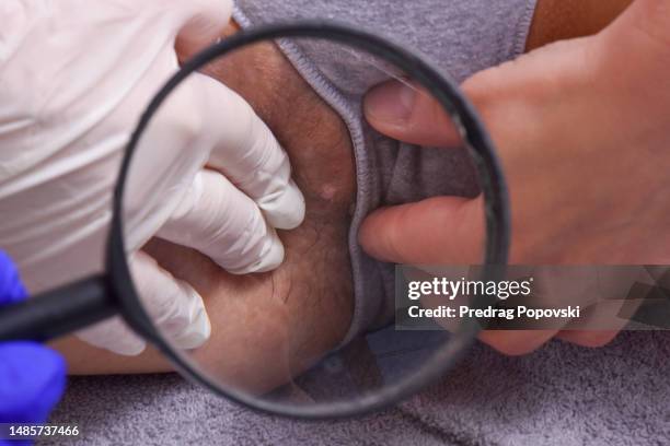 doctor checking infected skin with condyloma with magnifying glass - condiloma fotografías e imágenes de stock