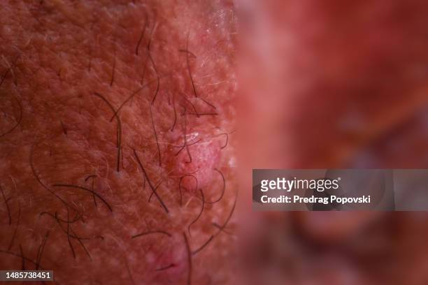 condyloma close up - treponema pallidum imagens e fotografias de stock