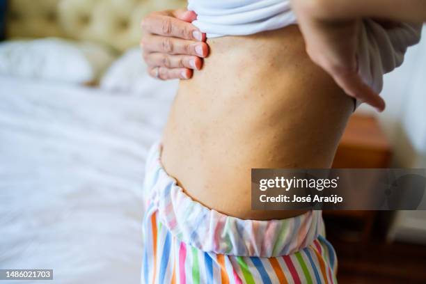 donna che mostra l'effetto della psoriasi lieve sul suo addome - dermatite atopica foto e immagini stock