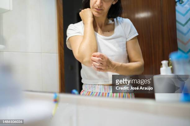 middle-aged woman watching the effect of psoriasis on her elbow and scratching - psoriasis stock pictures, royalty-free photos & images