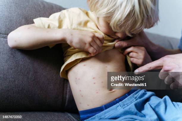father pointing finger and examining chickenpox on son at home - varicella foto e immagini stock