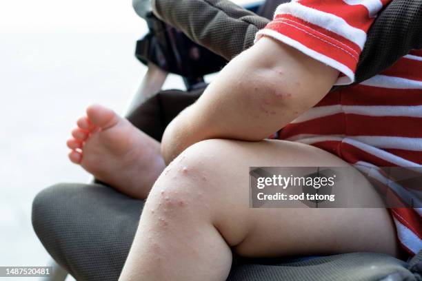 hand, foot, and mouth disease - eczema child stock-fotos und bilder