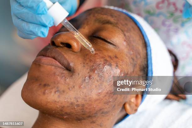 antibiotic facial mask applied to a black woman in a wellness spa center - blackhead stock pictures, royalty-free photos & images