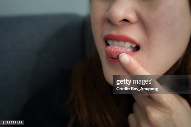cropped shot of woman having mouth ulcer occur on her tongue. mouth ulcers are painful sores that appear in the mouth. - zunge mund stock-fotos und bilder