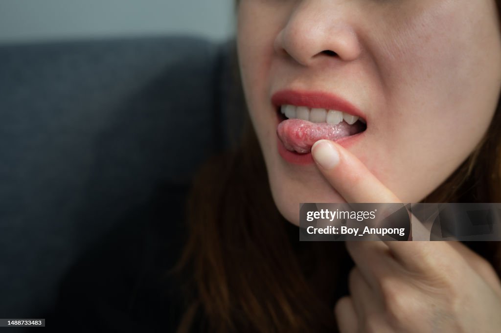 Cropped shot of woman having mouth ulcer occur on her tongue. Mouth ulcers are painful sores that appear in the mouth.
