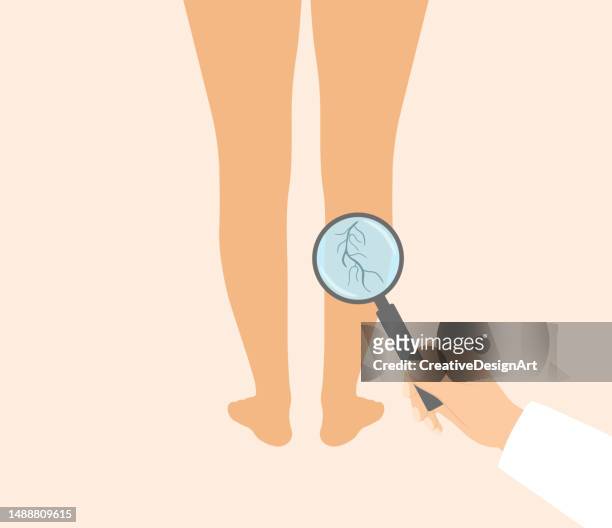 varicose veins, venous insufficiency and vascular disease concept. doctor holding a magnifying glass above woman legs with varicose veins - coagulation stock illustrations