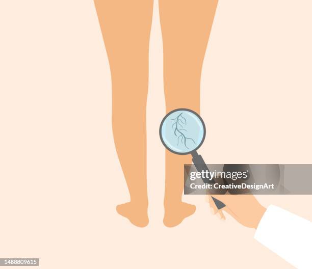 varicose veins, venous insufficiency and vascular disease concept. doctor holding a magnifying glass above woman legs with varicose veins - phlebitis stock illustrations