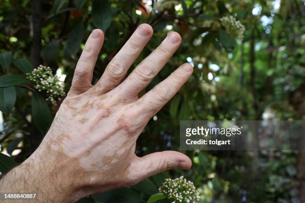 close-up of hands with vitiligo depigmentation - mottled skin stockfoto's en -beelden
