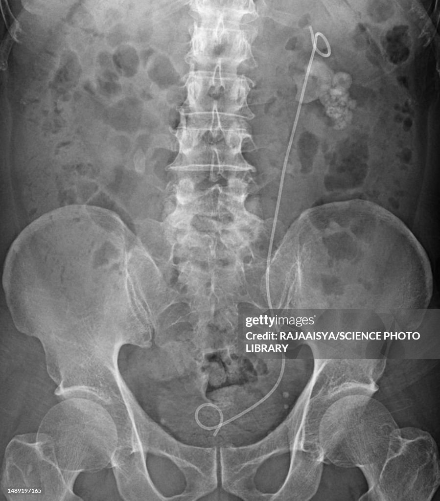 Stent String Urinary System Stent Xray High-Res Stock Photo - Getty Images