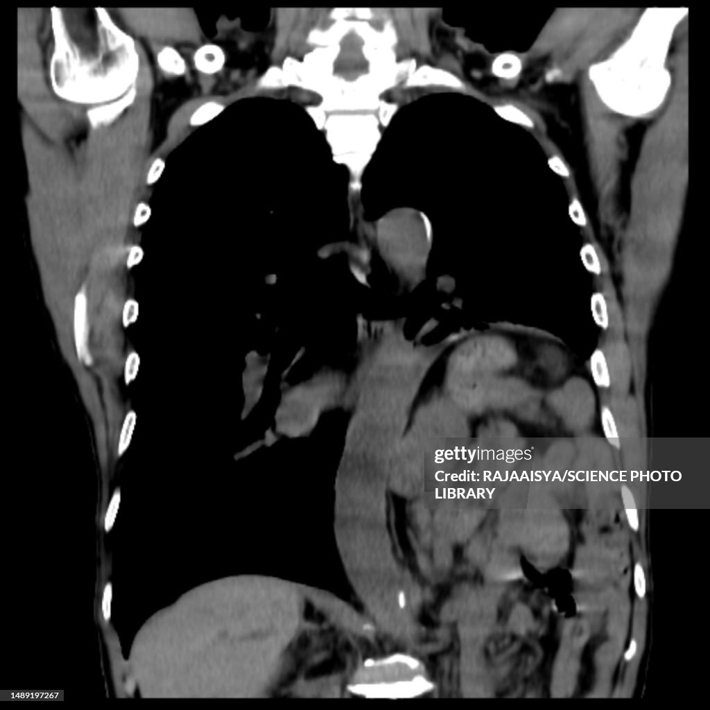 Hiatus hernia, CT scan