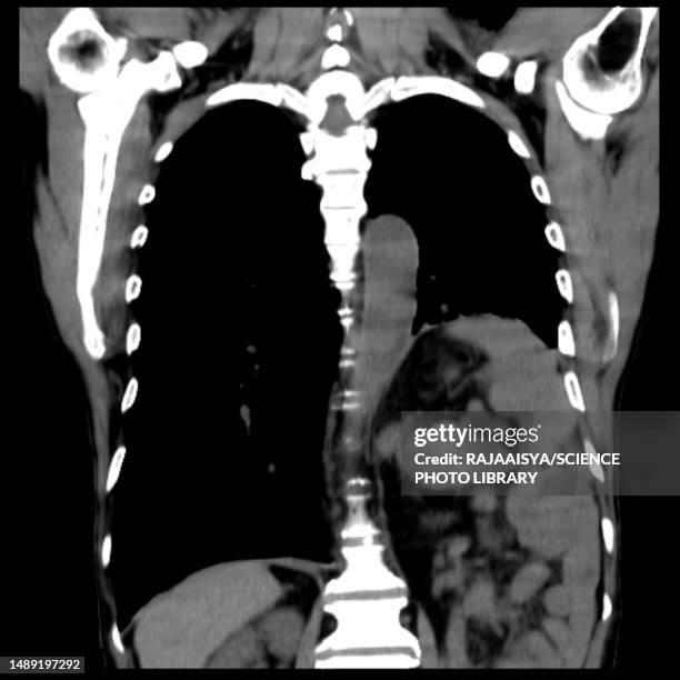 hiatus hernia, ct scan - hernia de hiato fotografías e imágenes de stock