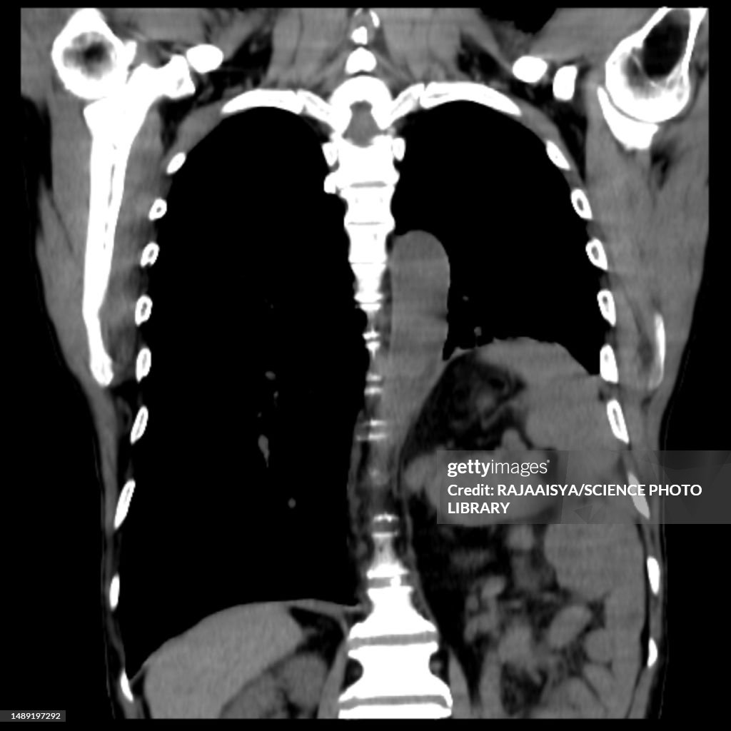 Hiatus hernia, CT scan