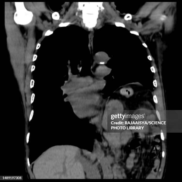 hiatus hernia, ct scan - hernia de hiato fotografías e imágenes de stock