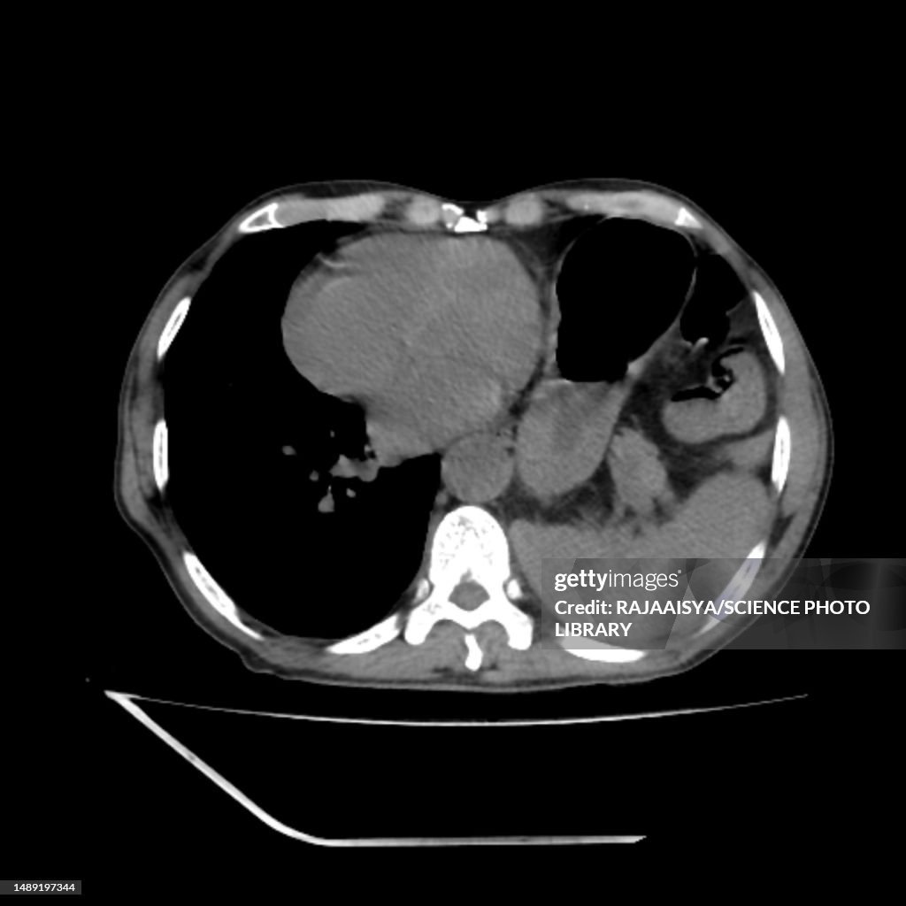 Hiatus hernia, CT scan