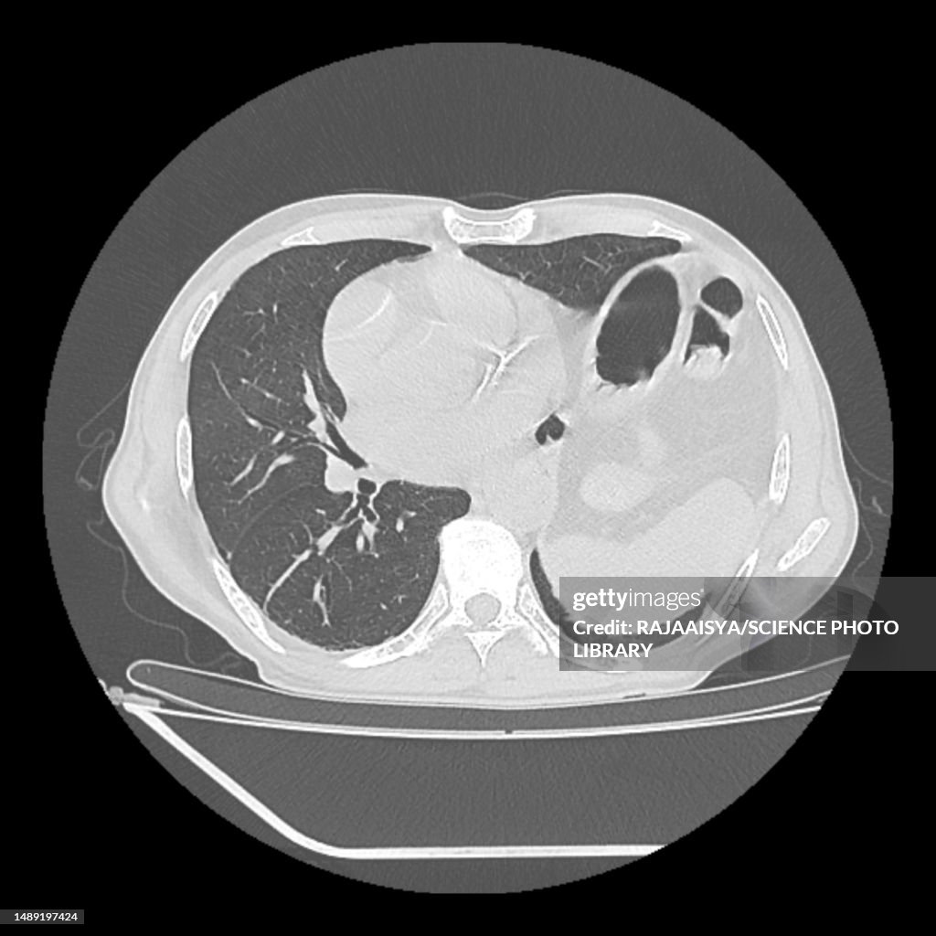 Hiatus hernia, CT scan